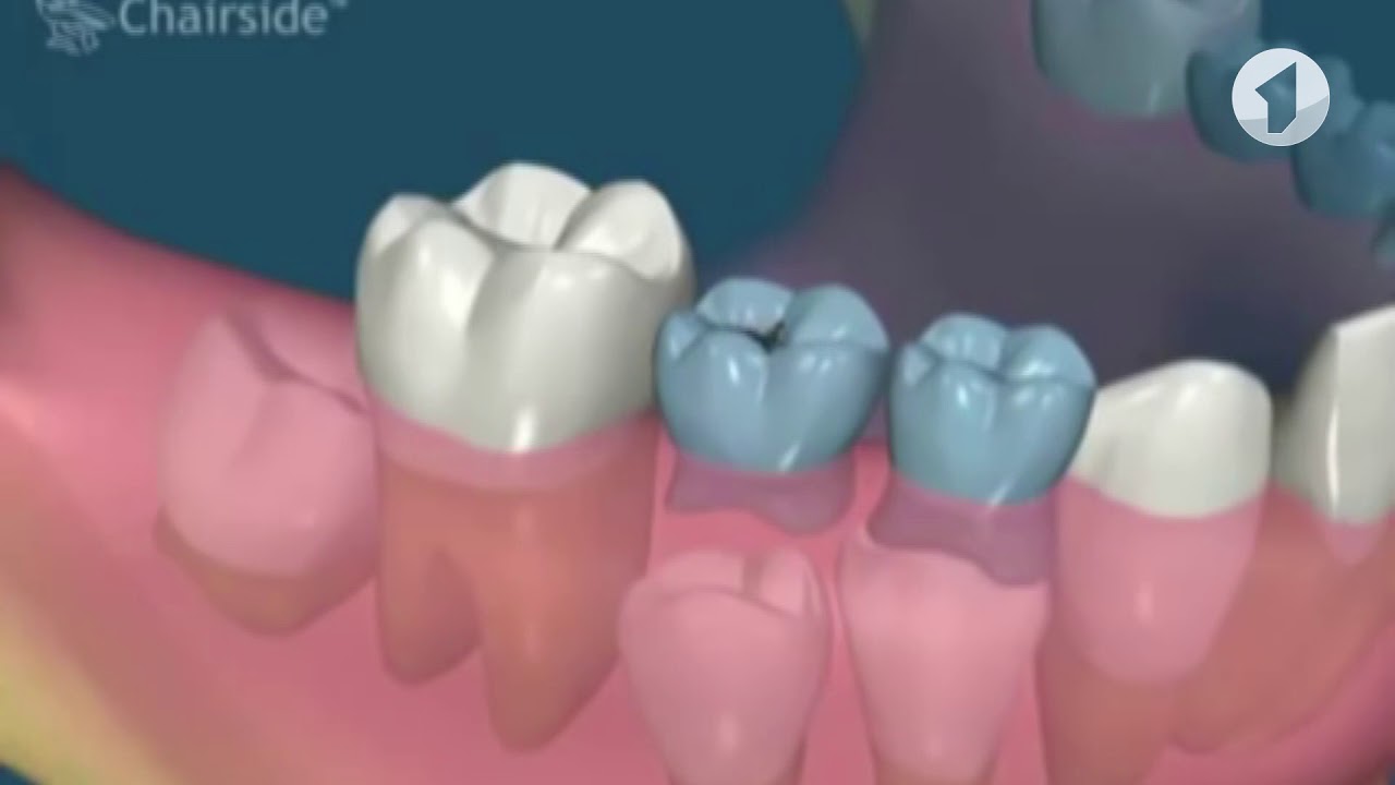 Может ли вырасти новый зуб. Молочный и постоянный зуб. Удаленные молочные зубы.