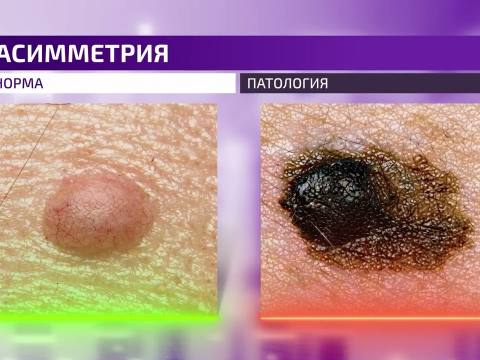 Дерматоскопия и родинки: как защитить себя от рака кожа / Здравствуйте