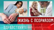 Жизнь с псориазом. Программа «Здравствуйте» – 26/03/23