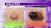 Дерматоскопия и родинки: как защитить себя от рака кожа / Здравствуйте