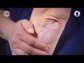 Что такое псориаз? / Здравствуйте